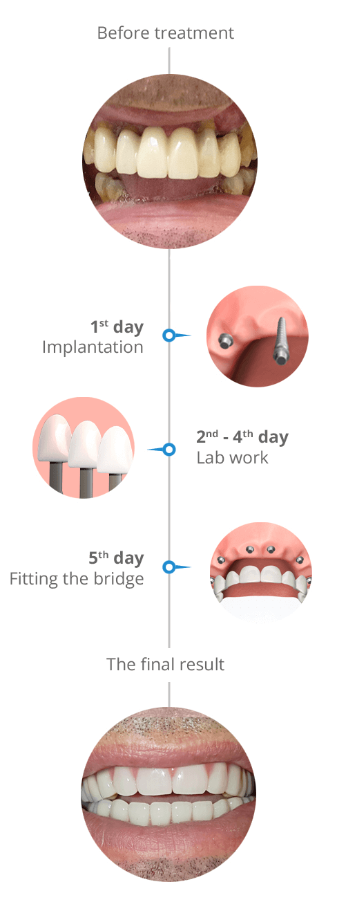 Swiss 5 day dental implant system - before and after